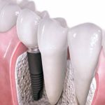 20140506_081304_implant-dental1