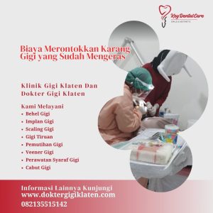 Biaya Merontokkan Karang Gigi yang Sudah Mengeras